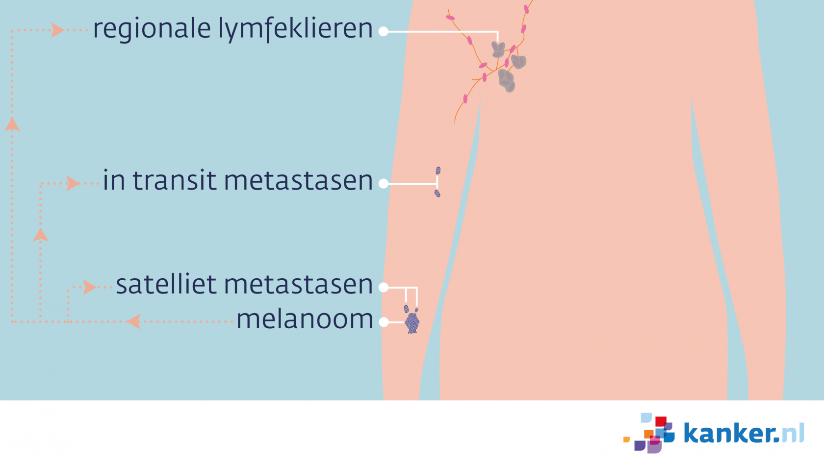 Uitzaaiingen bij een melanoom| kanker.nl